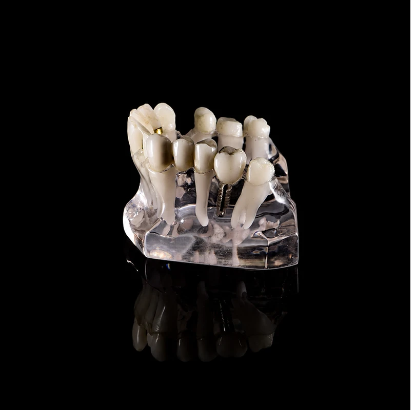 single dental implants